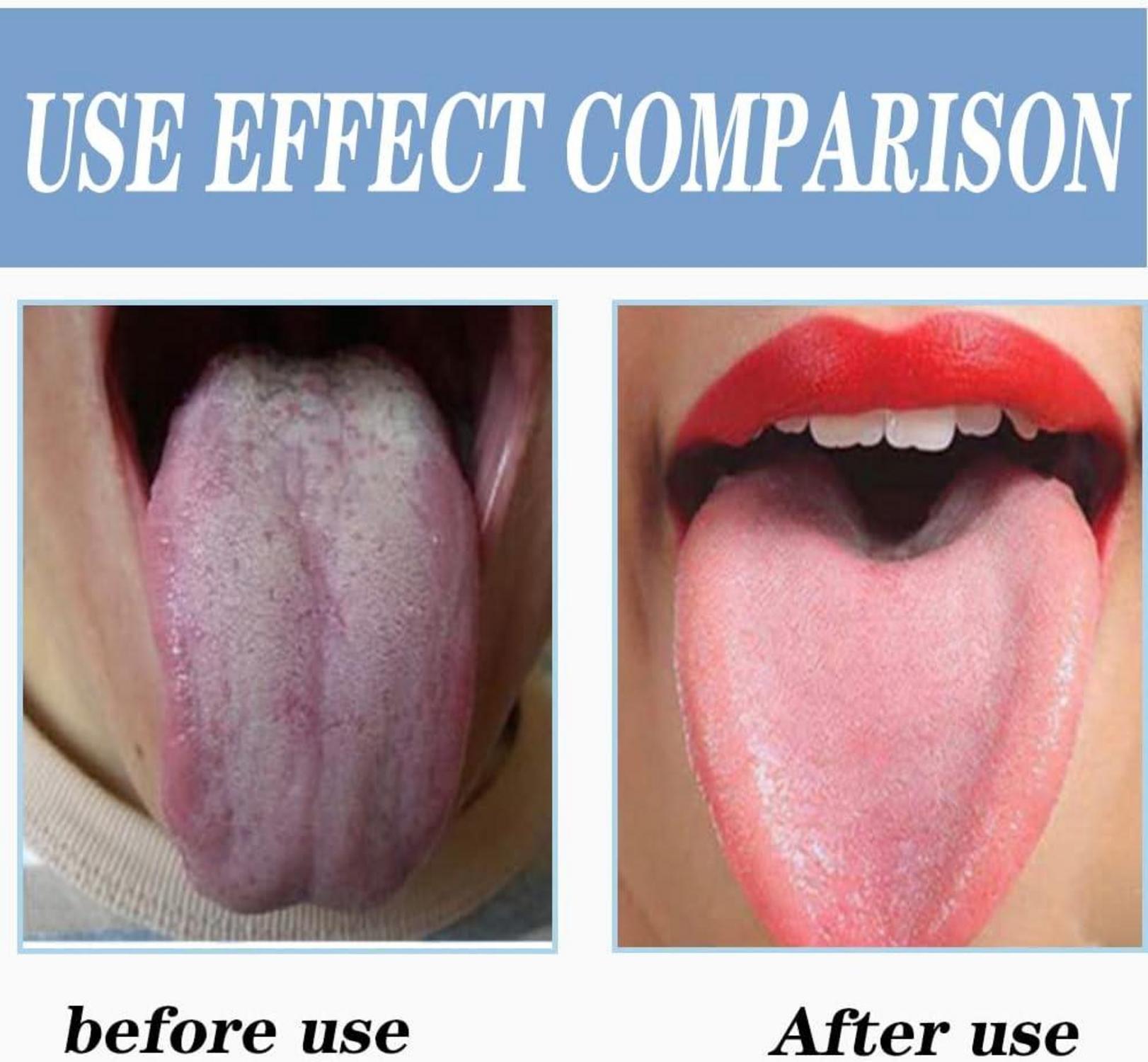 Zungenreiniger Edelstahl Tongue Scraper für frischen Atem