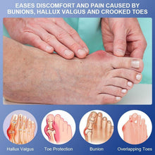 ACWOO Hallux Valgus Korrektur Schiene für Damen und Herren